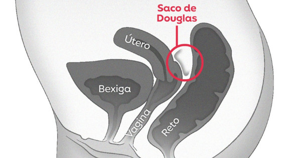 saco de douglas.png