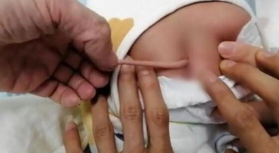 cauda em bebe