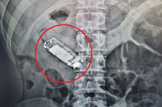 Aparelho celular ficou preso no intestino de detento em Alta Floresta/MT.