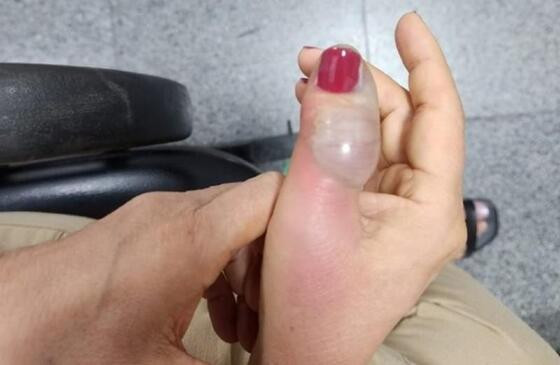 unha com infecção