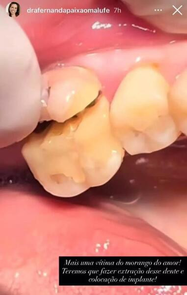 Dentista mostra caso de perda dentária 